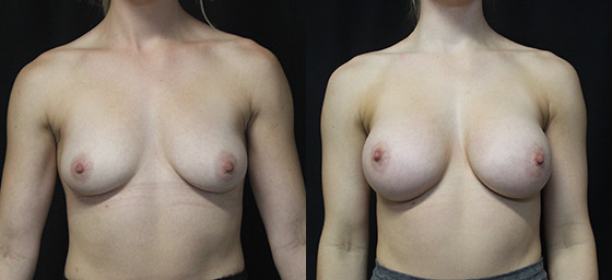 Breast Augmentation before and after photo by Kierney Chung Plastic Surgery in Puyallup WA